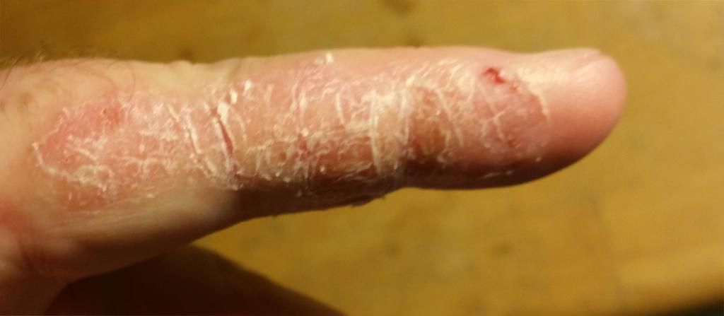 Itchy Hard Patches Of Skin On The Finger - HealthTap