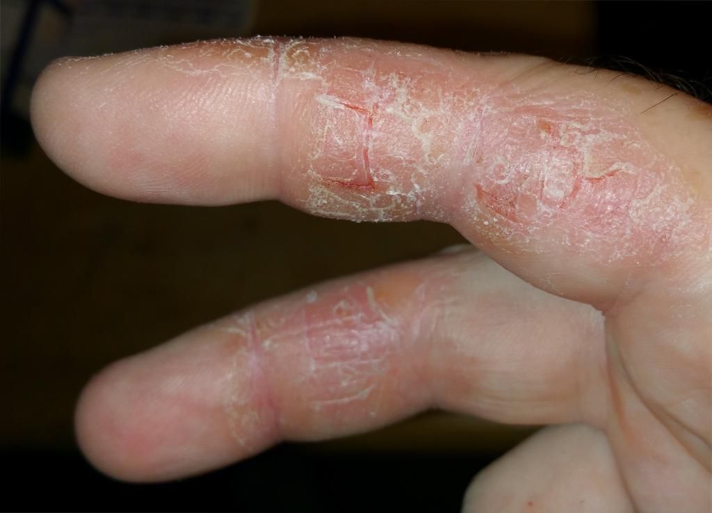 dry skin between fingers #9