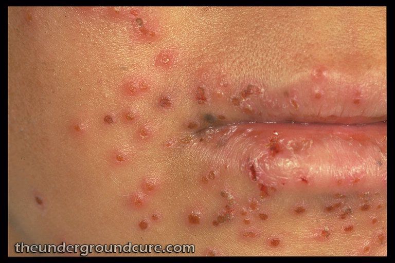 Herpes Simplex (Cold Sores and Genital Herpes ...