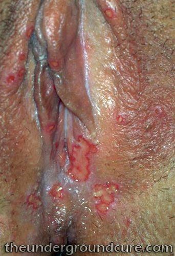 Got Herpes? Get Cured! (c) roberthoward62 genital herpes symptoms without sores