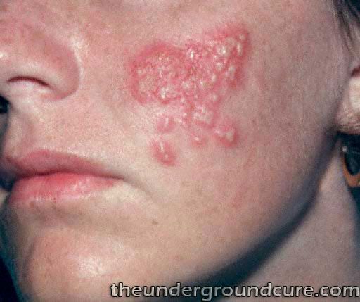 oral herpes in mouth